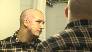 Mann mit vernarbtem Gesicht schaut sich im Spiegel an