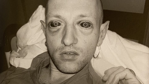 Liegender Mann mit Blutunterlaufenen Augen