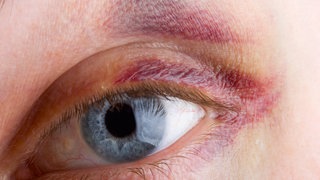 Auge mit Veilchen, also einem Hämatom