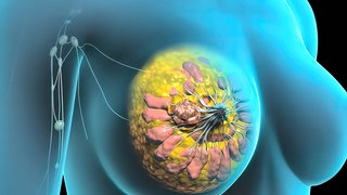 Illustration des Inneren einer Brusts. Vielen Menschen mit Krebs tut körperliche Bewegung gut. Aber wie wirken sich Ausdauer- oder Krafttraining konkret auf Tumore aus? Mehrere Forschungsteams haben nun bei Brustkrebspatientinnen in Heidelberg nach Antworten gesucht.