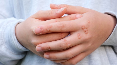 Gelangen HP-Viren durch kleinste Einrisse in die Haut, können sich dort Warzen bilden. Zum Beispiel an den Händen und Füßen, aber auch im Genitalbereich.