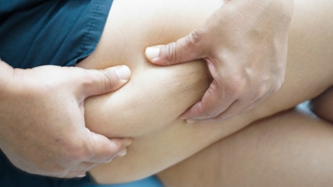Hände halten Falte eines Oberschenkels, tags: Diagnose Adipositas Übergewicht
