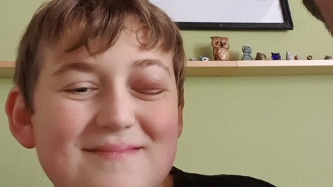 Zwölfjähriger Peter mit geschwollenem Auge, tags: Behandlung krebs Kinder krebskrank medikament