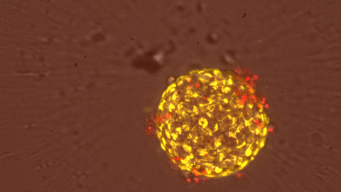 Minitumor unter dem Mikroskop, tags: Behandlung krebs Kinder krebskrank medikament