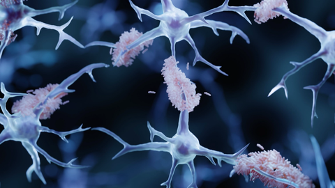 Diese Ablagerungen an den Nerven, Amyloid-Plaques, sammeln sich im Gehirn an und sind vermutlich der Hauptgrund für Alzheimer.