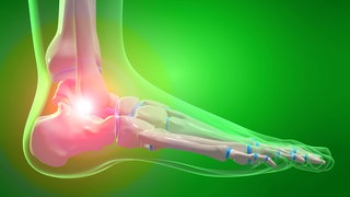 Arthrose im Fuß: Unter Arthrose versteht man eine primär verschleißbedingte Gelenkerkrankung, die prinzipiell alle Gelenke betreffen kann und verschiedene Ursachen hat