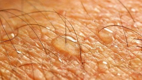 Der Schweißgeruch auf der Haut trägt unter anderem dazu bei, wie sehr uns Mücken anziehend finden.