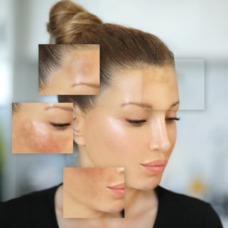 Frau mit Pigmentflecken