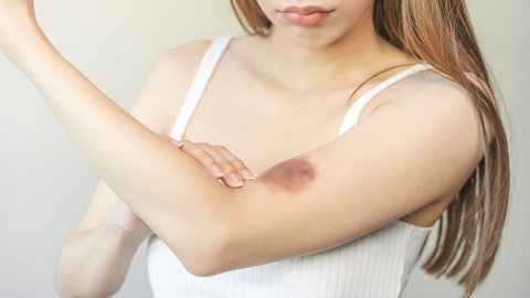 Junge Frau betrachtet blauen Fleck auf ihrem Arm 