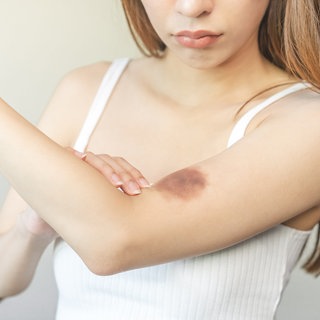 Junge Frau betrachtet blauen Fleck auf ihrem Arm 