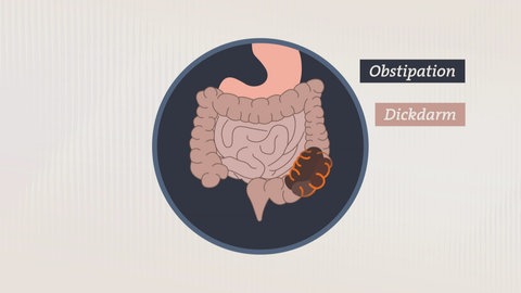 Abbildung des Darms, im Dickdarm befindet sich Stuhl