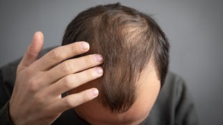 Mann mit Geheimratsecken und dünnem Haarwuchs. Haarverlust betrifft Männer und Frauen, die Ursachen sind vielfältig. Haarausfall kann auch zu psychischen Problemen führen. Was helfen kann – von Koffein bis Transplantation.