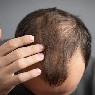 Mann mit Geheimratsecken und dünnem Haarwuchs. Haarverlust betrifft Männer und Frauen, die Ursachen sind vielfältig. Haarausfall kann auch zu psychischen Problemen führen. Was helfen kann – von Koffein bis Transplantation.