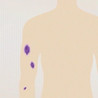 Grafik: drei Hämatome