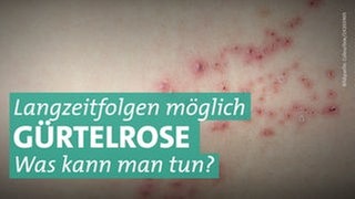 Rote Bläschen auf heller Haut. Wie gut hilft die Impfung gegen Herpes zoster oder Gürtelrose? Wie häufig kommen Spätfolgen vor?