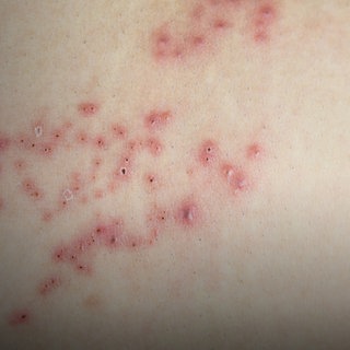 Rote Bläschen auf heller Haut. Wie gut hilft die Impfung gegen Herpes zoster oder Gürtelrose? Wie häufig kommen Spätfolgen vor?