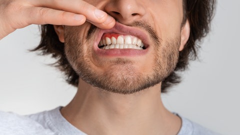 Mann zeigt Entzündung der Mundschleimhaut 