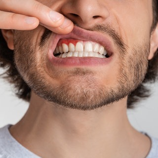 Mann zeigt Entzündung der Mundschleimhaut 