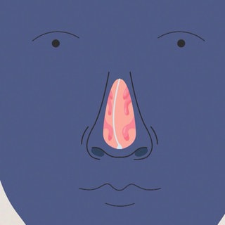 Grafik: Verkrümmung der Nasenscheidewand