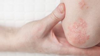 Ellenbogen mit rötlicher Schuppenflechte. Was hilft bei Psoriasis und Psoriasis Arthritis?