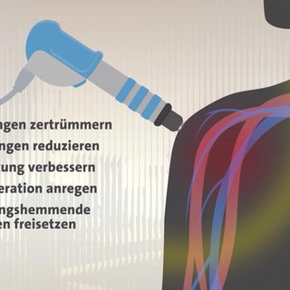 Grafik zur Erläuterung der Stoßwellentherapie