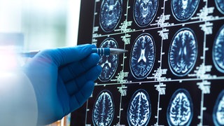 Hand mit blauem Handschuh zeigt mit Stift auf MRT-Ergebnisse eines Gehirns 