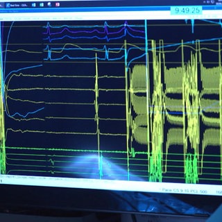 Vorhofflimmern – neue Behandlungsmöglichkeit mit weniger Nebenwirkungen