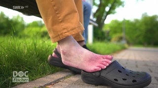 ein von Wundheilungsstörungen betroffener Fuß