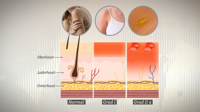 Die Grafik zeigt Verbrennungen der Grade 1 und 2a. Erste Hilfe bei Brandwunden - soll man Verbrennungen kühlen?