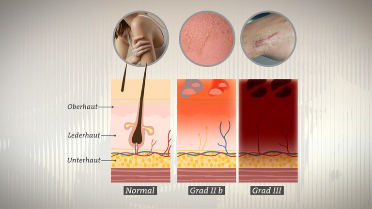 Die Grafik zeigt Verbrennungen der Grade 2b und 3. Erste Hilfe bei Brandwunden