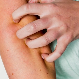 Person kratzt sich am Arm.