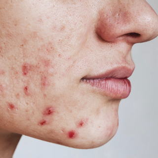 Gut zu Wissen Akne im Alter