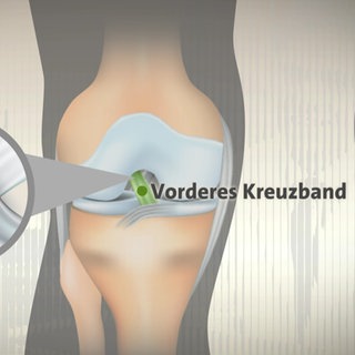 Grafik, die anzeigt, wo das Kreuzband im Knie verläuft. Wird das Knie falsch belastet, kann das Kreuzband reißen.