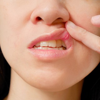 Was man bei Aphten tun kann