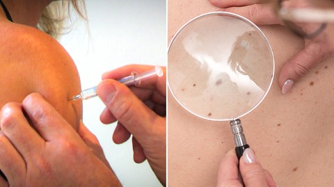 Eine Impfung gegen Hautkrebs ist in der Studie