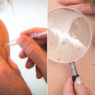 Eine Impfung gegen Hautkrebs ist in der Studie