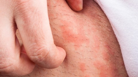 Eichenprozessionsspinner: Kontakt kann auf der Haut zu einem Ausschlag wie bei Nesselsucht führen.