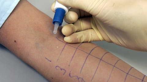 Auf den Unterarm eines Patienten werden Allergene aufgebracht, um Allergien wie Heuschnupfen zu erkennen. Beim Pricktest wird die Haut zusätzlich sanft eingestochen.