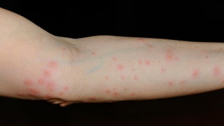 Rote juckende Pusteln auf einem Arm, ausgelöst durch Bisse der Larve der Grasmilbe