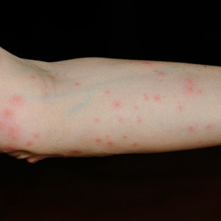 Rote juckende Pusteln auf einem Arm, ausgelöst durch Bisse der Larve der Grasmilbe