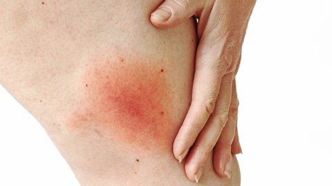 Ein Bein mit einem roten Fleck, nach einem Zeckenbiss.