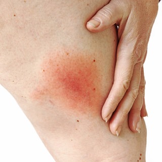 Ein Bein mit einem roten Fleck, nach einem Zeckenbiss.