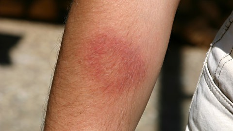 Ein roter Ring auf der Haut deutet auf eine Borreliose-Infektion hin, die durch einen Zeckenbiss ausgelöst wurde.