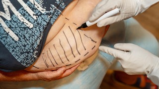 Adipositas-Experte über Übergewicht, Magen-OP und Abnehmspritze