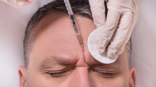 2024 gab es laut der Vereinigung Deutscher Ästhetisch-Plastischer Chirurgen 3.605 Botox-Behandlungen bei Männern.