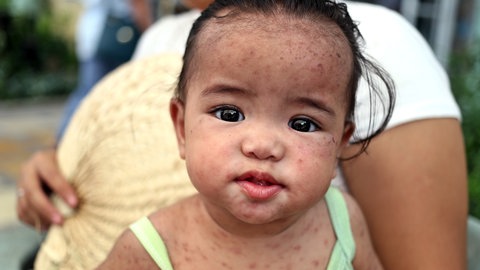 Kleinkind mit Aussschlag auf der Haut, es ist mit Masern infiziert.