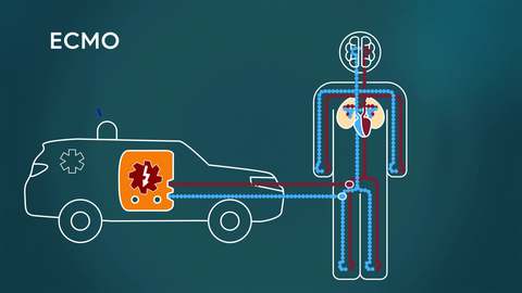 Die mobile ECMO wird im Notfall über das Bein an den Blutkreislauf angeschlossen. Die "künstliche Lunge" versorgt das Blut mit Sauerstoff.