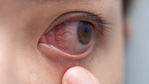 Eine Bindehautentzündung ist ein typisches Symptom einer Infektion mit dem Adenovirus. Die Augen sind gerötet und jucken.