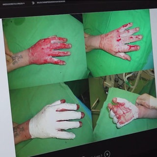 Vier Aufnahmen von Händen von Brandopfern