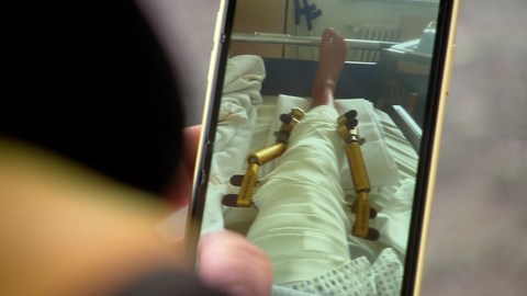 Auf einem Handyfoto ist ein verbundenes Bein mit Schiene zu sehen.
